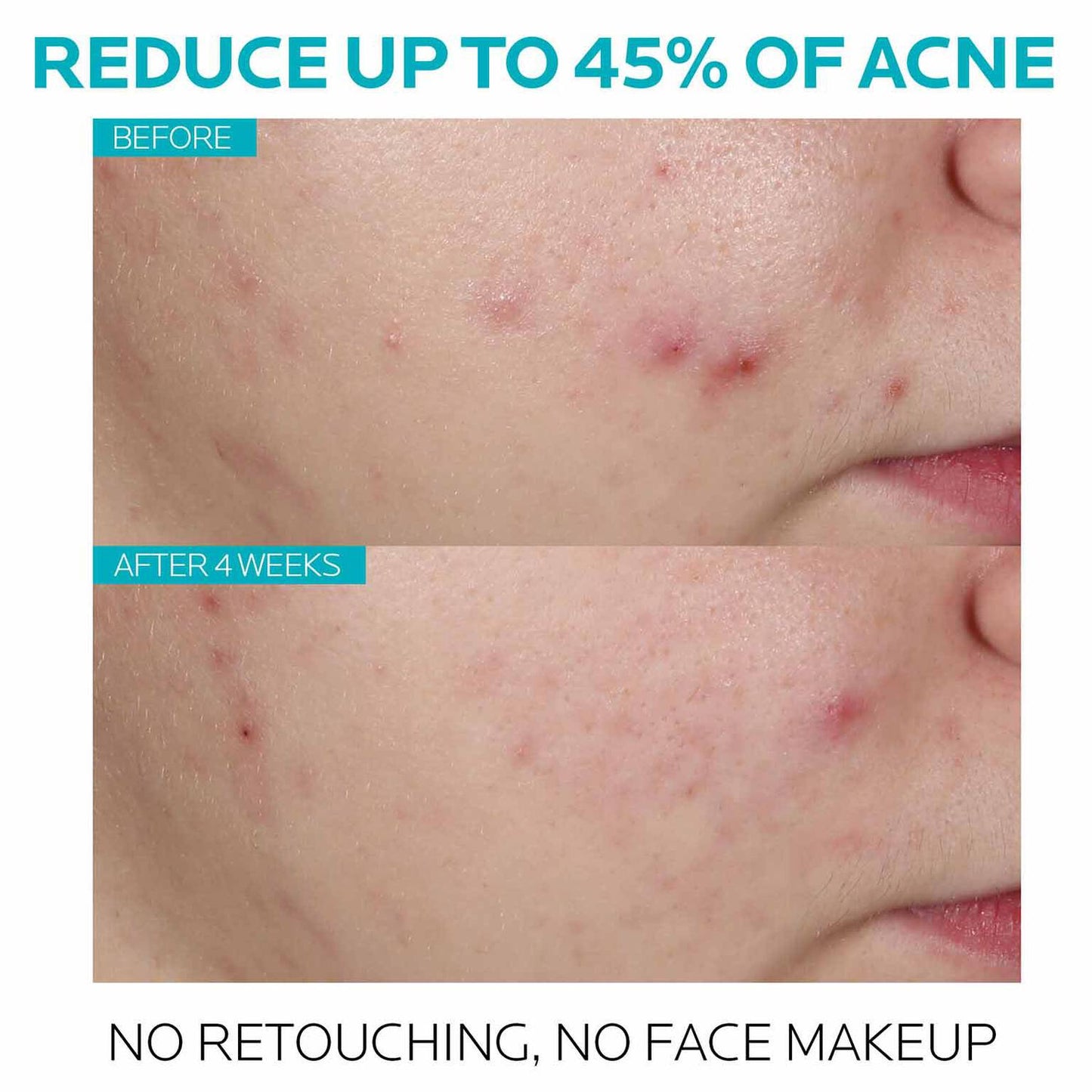 effaclar-salicylic-acid-acne-treatment-serum-o3 7_EffaclarSerum_After-45-days.jpg