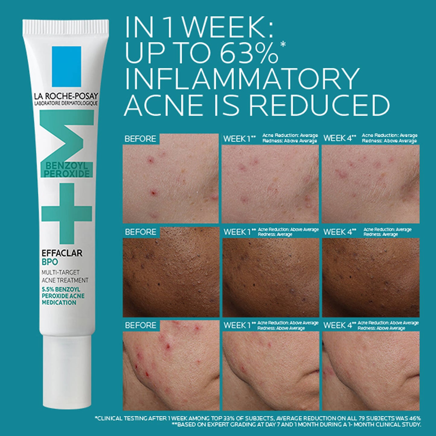 effaclar-bpo-multi-target-acne-treatment-with-5-5-benzoyl-peroxide-h0 EffaclarBPO-ClinicalBA-ATF-1500x1500-2.jpg