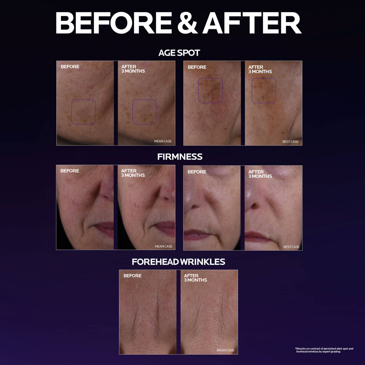 mela-b3-double-dose-discoloration-treatment-with-melasyltm-q6 MelaB3_DD_BTF_BeforeAfter_1500x1500_5.jpg